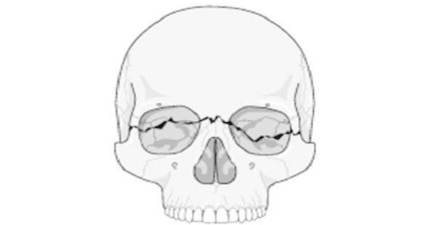 Fracture of the facial bones-Nose,Maxilla,Mandible,Zygomatic