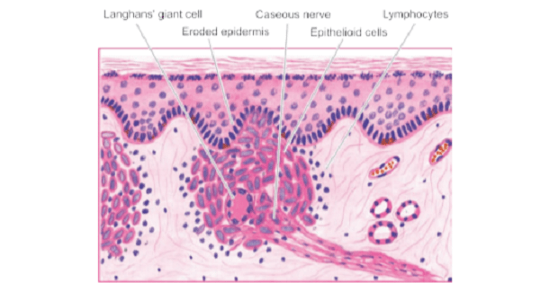 Leprosy Classification-Madrid and Ridley and Jopling Classification