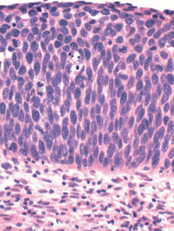 Cervical intraepithelial neoplasia (CIN) - New