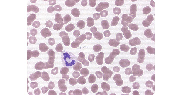 Borrelia and Relapsing Fever