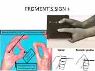 ULNAR NERVE INJURY New ULNAR NERVE INJURY New