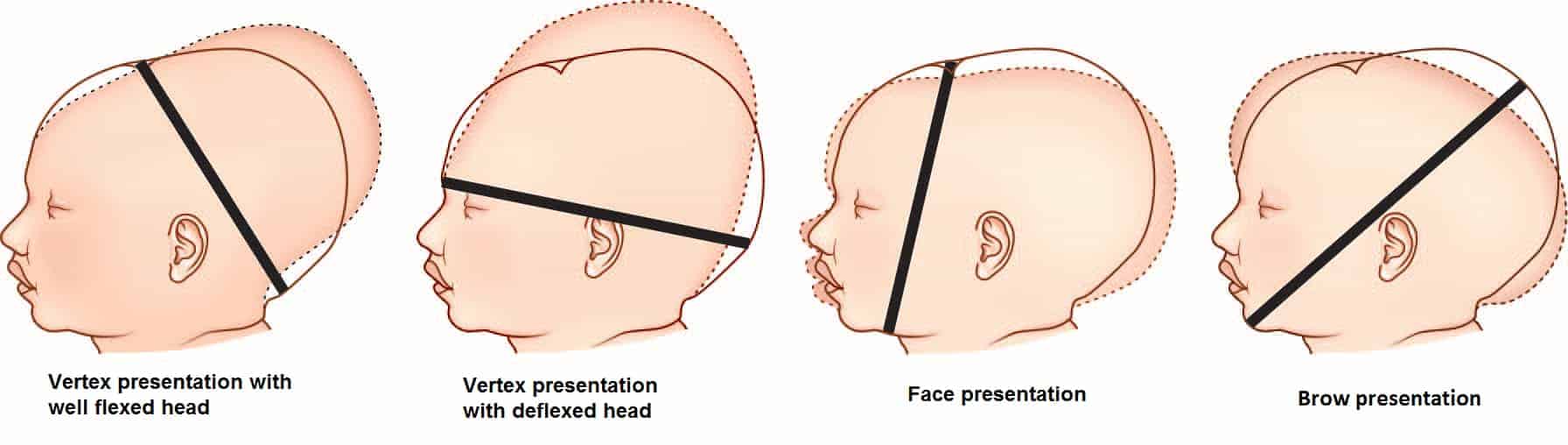 Fetal Skull - www.medicoapps.org