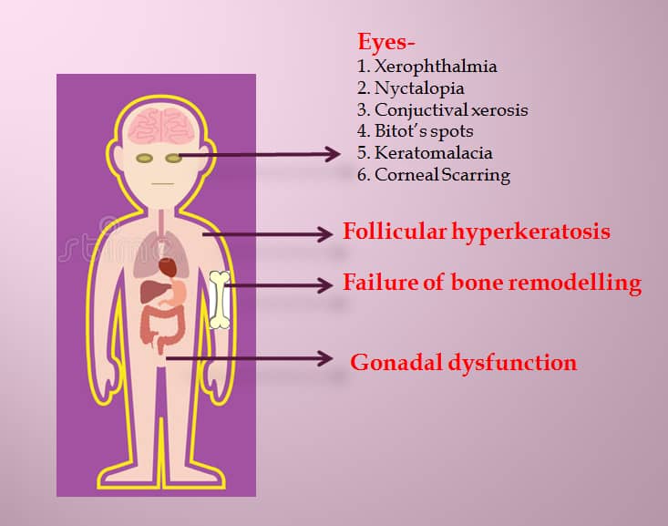Vitamin A Deficiency