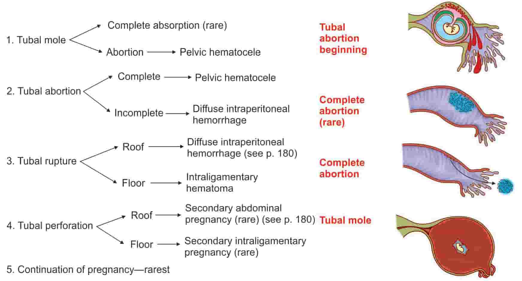 Ectopic pregnancy (Chapter 31) - Ultrasonography in Reproductive Medicine  and Infertility