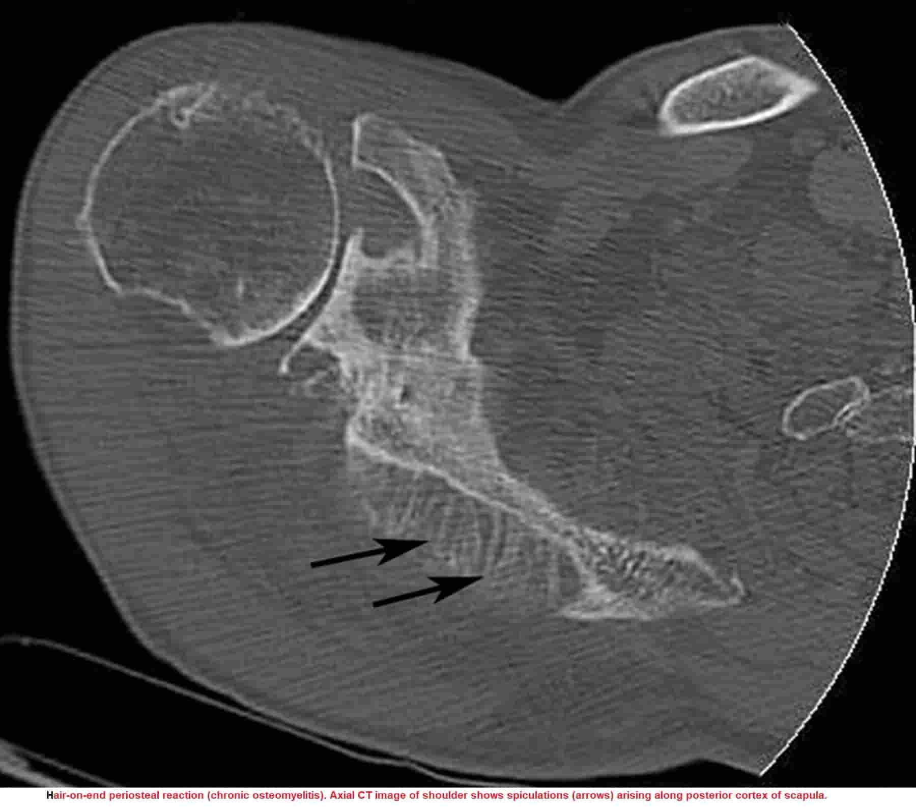 PERIOSTEAL REACTION New