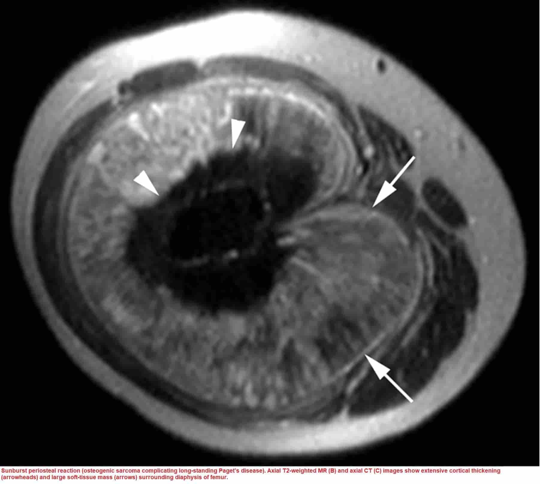 PERIOSTEAL REACTION - New