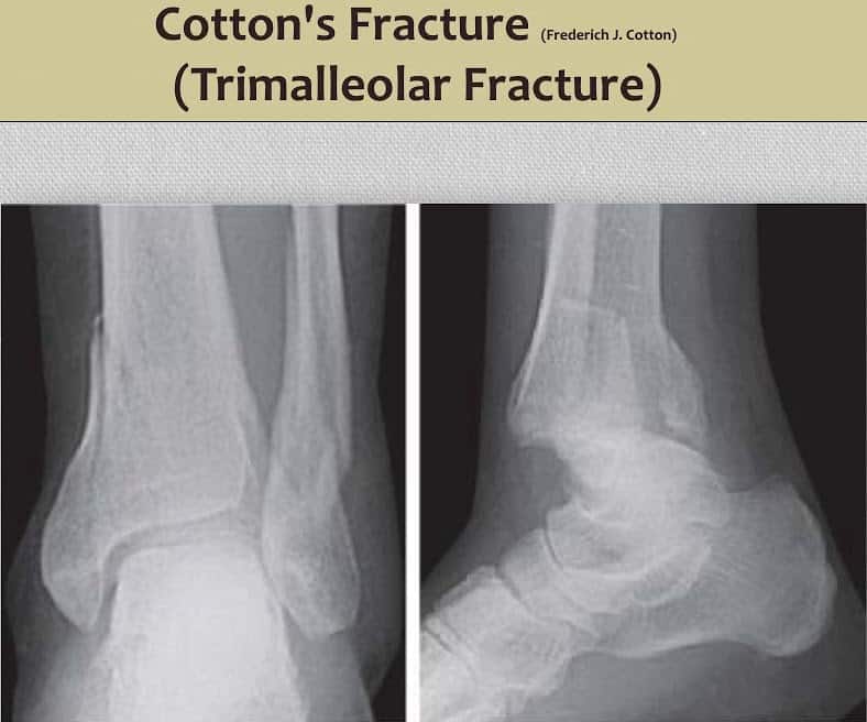 INJURIES AROUND THE ANKLE (Pott’s Fracture) New