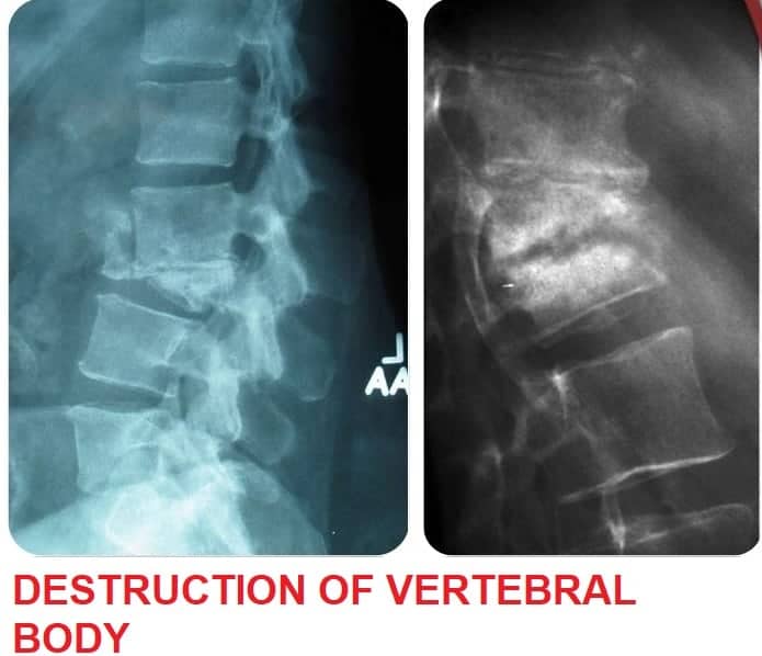 TUBERCULOSIS OF SPINE (Pott's disease)