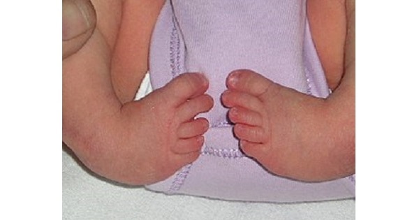 Congenital Clubfoot - www.medicoapps.org
