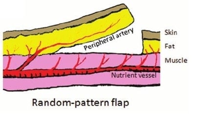 Random Pattern Flasps Random pattern flap - New