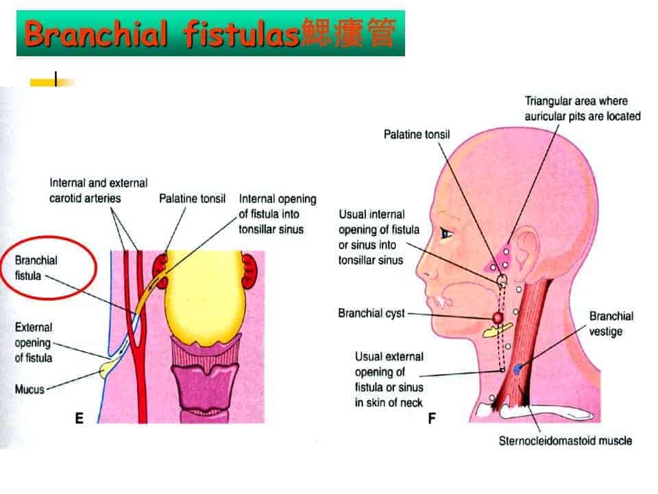 BRANCHIAL FISTULA