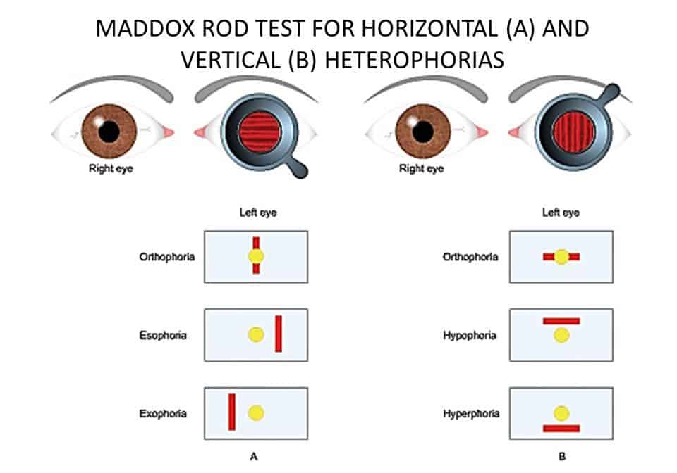 Diplopia Double Vision Test Exam Brain Nerve Dry Eye Palsy, 51 OFF