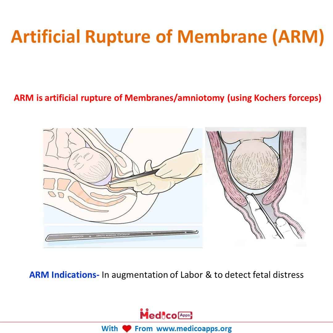 Arm Induction 20220323010315 - New